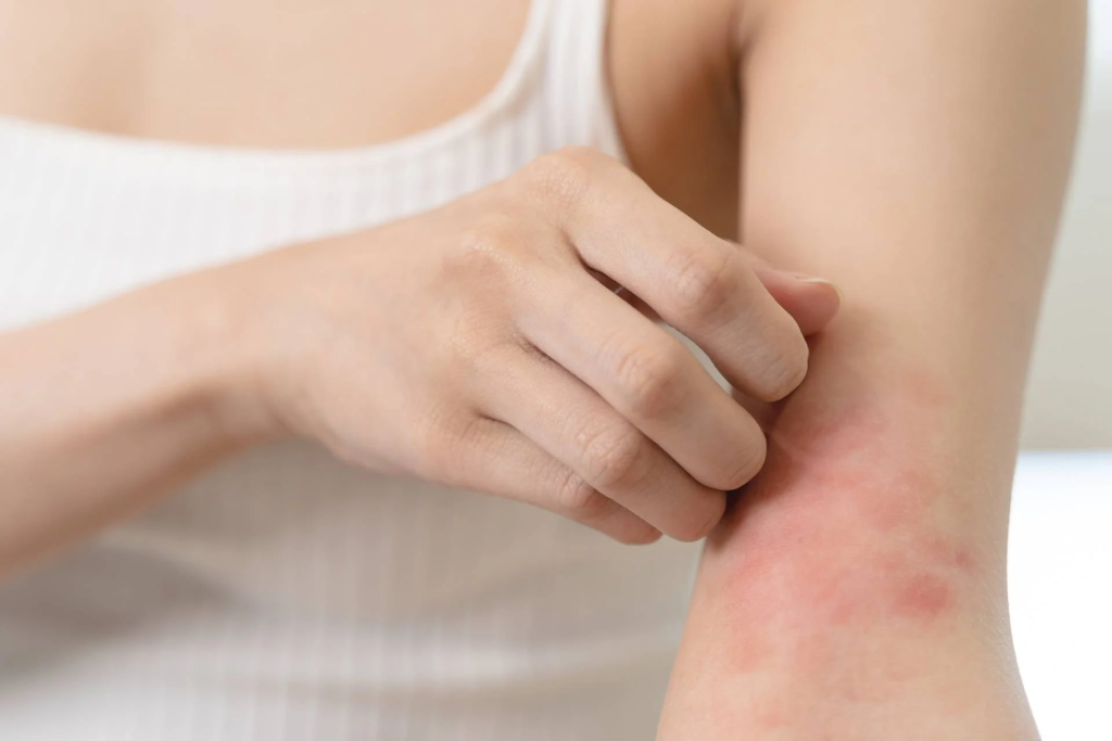 dermatitis atópica en verano síntomas irritación piel