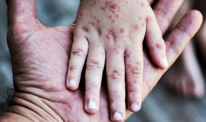 Sarampión: el brote sumó un nuevo caso y hay 500 personas en vigilancia epidemiológica