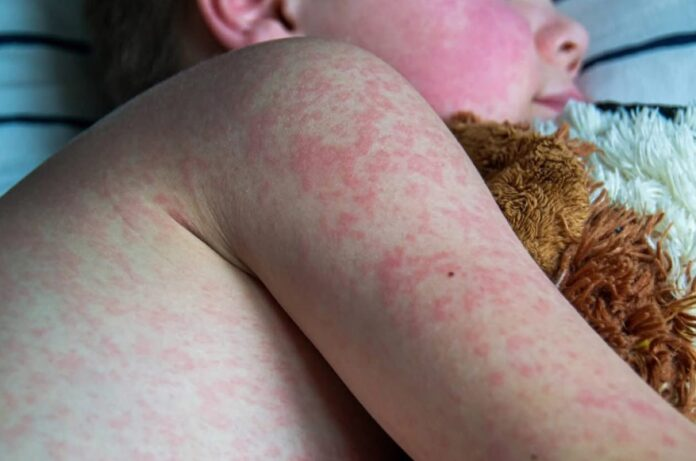 Sarampión: comenzó la campaña de vacunación de refuerzo en AMBA a niños de entre 6 meses y 5 años
