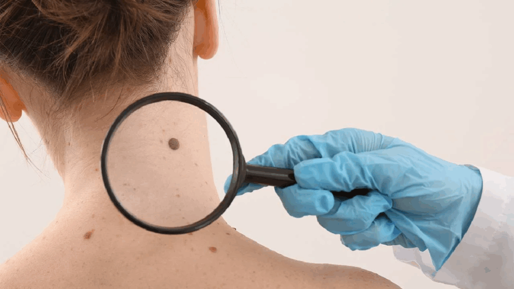 día mundial del melanoma cáncer