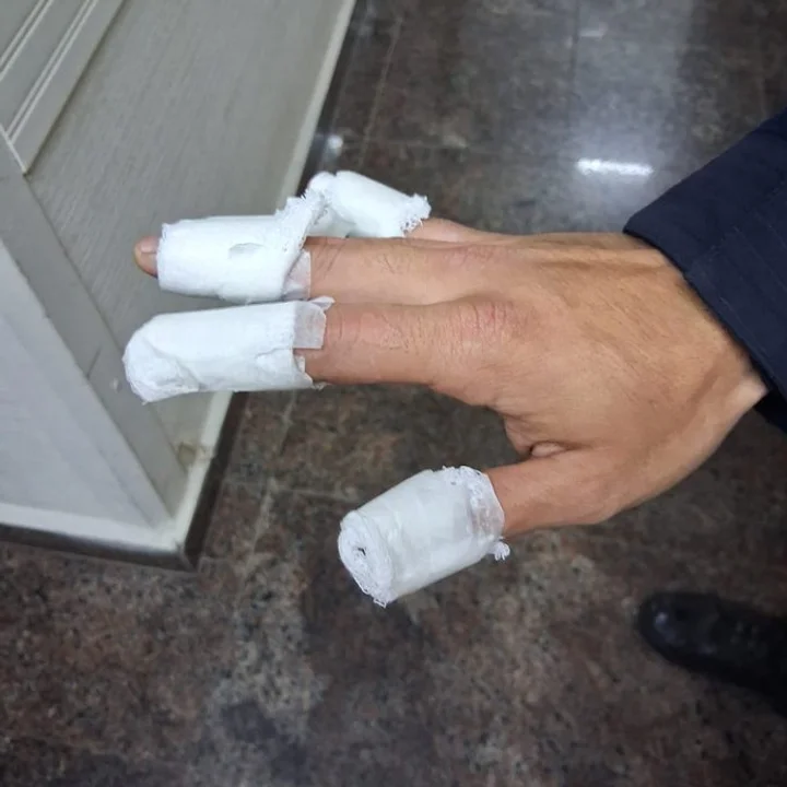 policía quemados