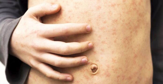 Sarampión: hay cuatro brotes en curso y siguen sumando los contagios