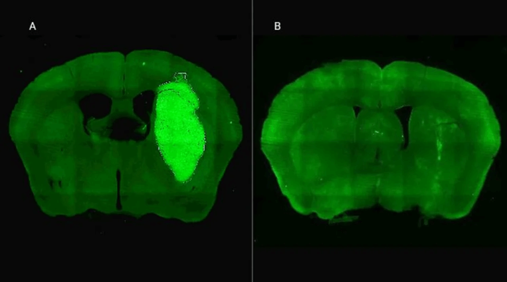 glioblastoma especialistas del conicet