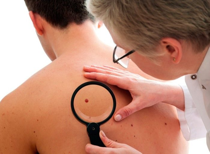 enemigo piel diagnóstico melanoma cáncer