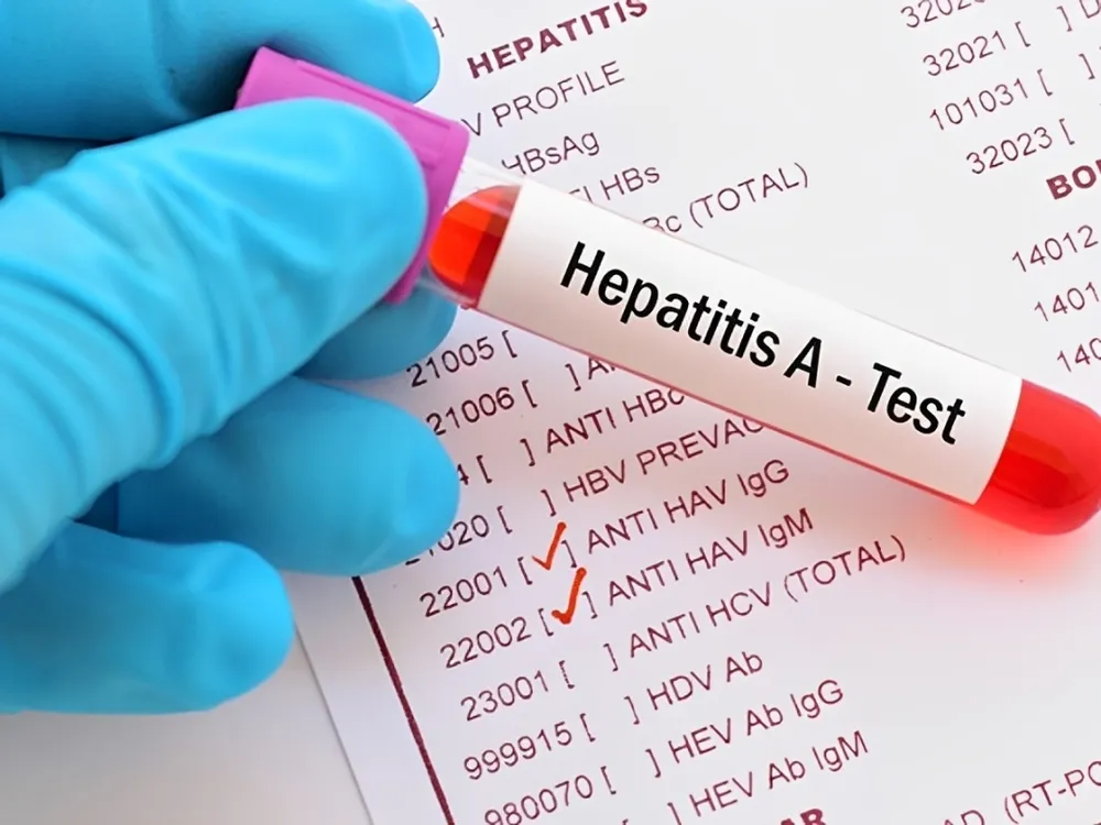 Hepatitis A: tras la confirmación de los 32 casos, el país entró en zona de alerta sanitaria